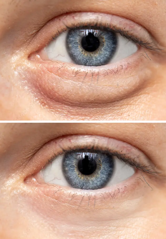 BLEFAROPLASTIA​